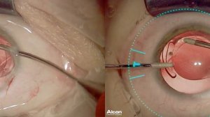 3D Имплантация ИОЛ ALCON PANOPTIX TORIC (хирург д.м.н. профессор кафедры Стебнев В.С.)