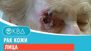 ? Рак кожи лица. Клинический случай №1030
