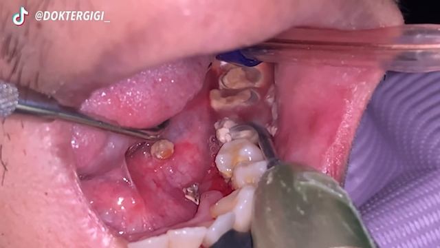 TARTAR SCALING | Dentist | Dokter Gigi Tri Putra смотреть онлайн