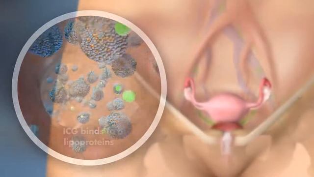 SPY Fluorescence Imaging For Lymphatic Mapping In Gyn Onc