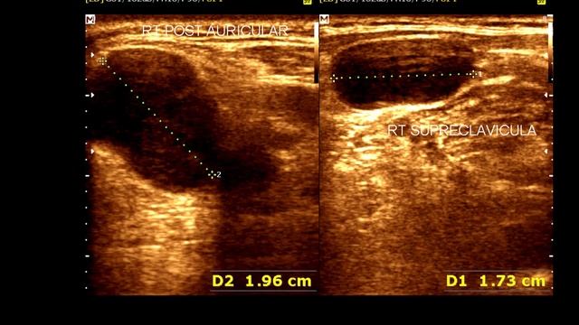 Cervical lymphadenopathy | Normal Thyroid Gland | Ultrasound Cervical Lymph Node смотреть онлайн