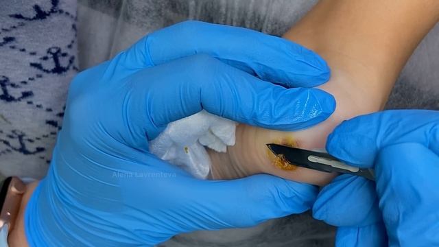 Бородавка у ребенка в 10 лет / Удаление бородавки / Бородавка на ноге что делать / Удалили лазером