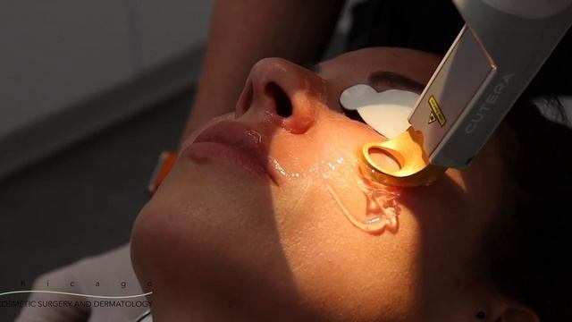 Excel V Laser for Redness Explained | Chicago Cosmetic Surgery and Dermatology смотреть онлайн
