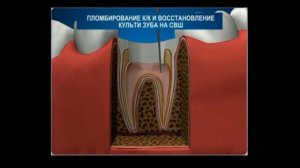 Реставрация зуба на стекловолоконных штифтах
