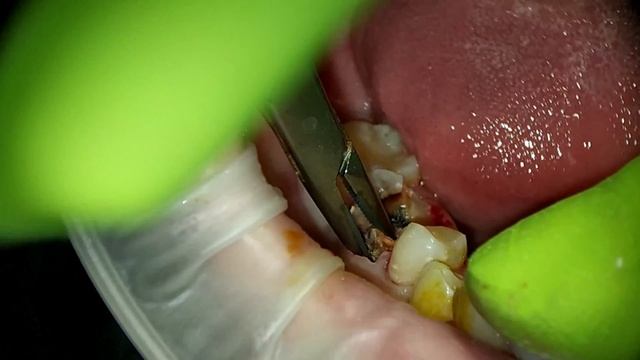 Удаление зуба, нижнего моляра с распиливанием и извлечением по корням смотреть онлайн