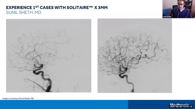 First Case Experiences with Solitaire X 3mm Revascularization Device смотреть онлайн