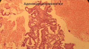 Аденокарцинома матки