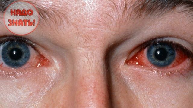 Почему лопаются сосуды в глазах? смотреть онлайн