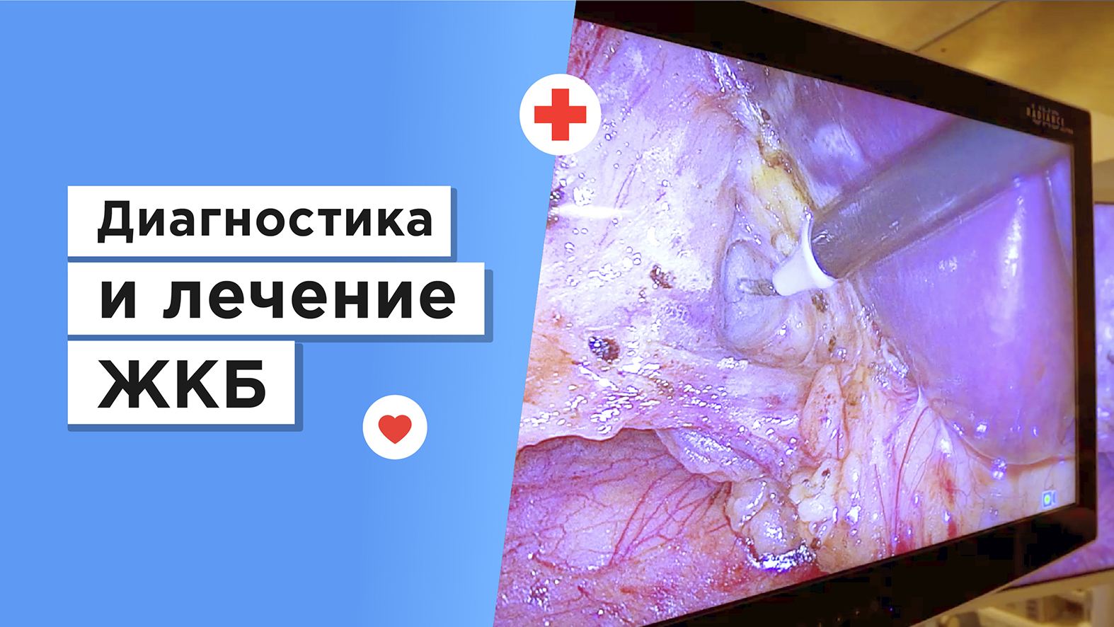 Диагностика и лечение желчнокаменной болезни (ЖКБ) смотреть онлайн