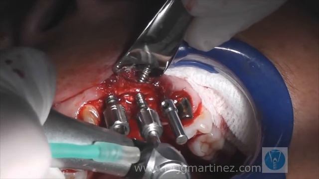 Piezotome Alveolar Crest Split with BS5-Tip in the Upper Front and Implant Insertion смотреть онлайн