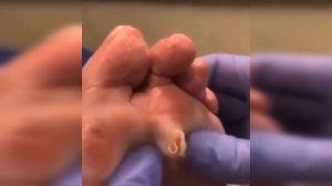 подборка выдавливания прыщей 7 II выдавливание прыща