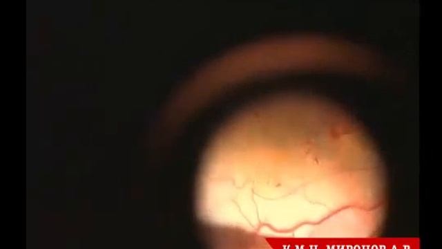 Эпиретинальный фиброз смотреть онлайн