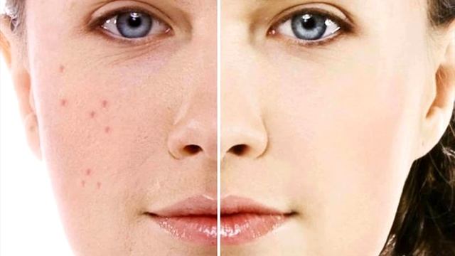 Как избавиться от прыщей за 1 час? смотреть онлайн