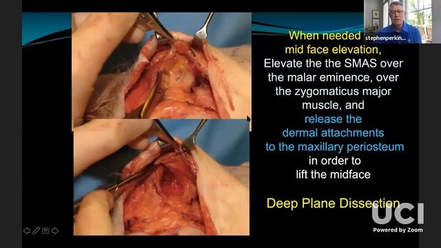Ep.14 | SORSSA | Extended SMAS Deep Plane Facelift With Anterior Platysmaplasty | Dr S Perkins