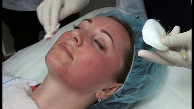 Противопоказания к биоревитализации смотреть онлайн