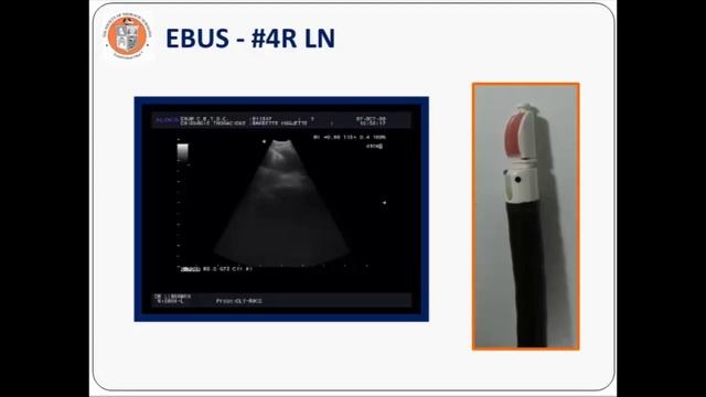 Mediastinal Staging Webinar смотреть онлайн