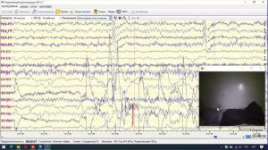 Как научиться расшифровывать ЭЭГ