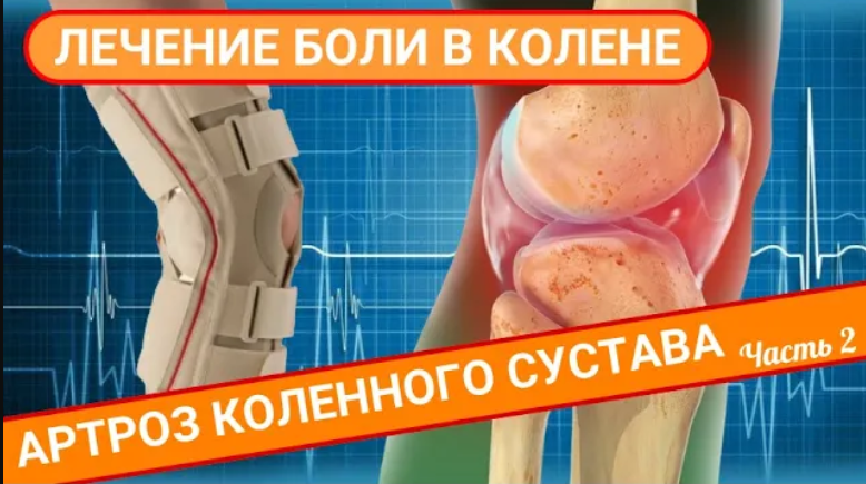ЛЕЧЕНИЕ БОЛИ В КОЛЕНЕ. Артроз коленного сустава (Часть 2) смотреть онлайн