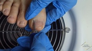 2 ПЕДИКЮРА/ВРОСШИЕ ногти/Педикюр сама себе