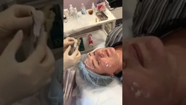Процедура пилинга косметологический филиал поликлиника Альбина Курск