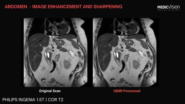 Enhancing 1.5T MRI abdomen images to 3T quality. Philips INGENIA 1.5T ABDOMEN COR T2 смотреть онлайн
