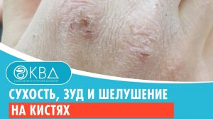 ? Сухость, зуд и шелушение на кистях. Клинический случай №983