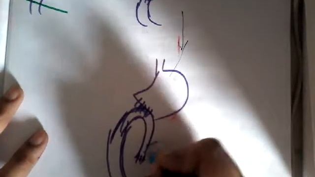 Bilroth type 2 surgery || stomach || git смотреть онлайн