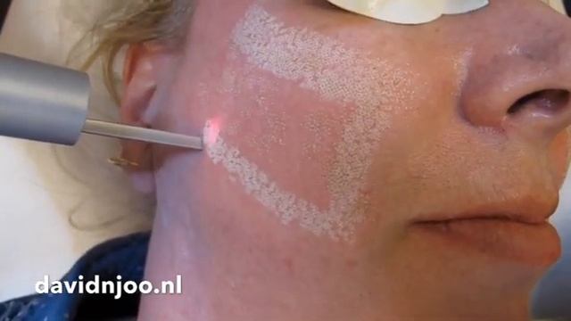 CO2 laser of deep acne scars in the fair skin смотреть онлайн