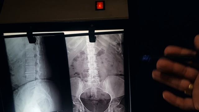 Lower Back X RAY How to Read, L4 L5 S1 Lumbosacral X Ray Reading, Lumbar Spine X RAY Complete Study смотреть онлайн