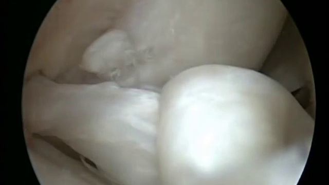 КОМБИНИРОВАННЫЙ РАЗРЫВ (ЛОСКУТНЫЙ + «РУЧКА ЛЕЙКИ») ЗАДНЕГО РОГА МЕДИАЛЬНОГО МЕНИСКА смотреть онлайн