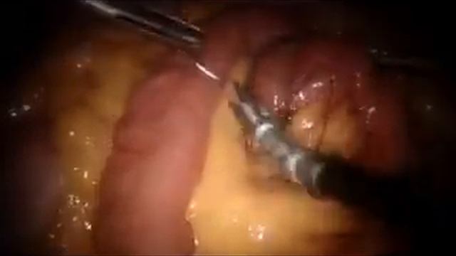 BYPASS DR KIM 4 ARM FLORIDA HOSPITAL смотреть онлайн