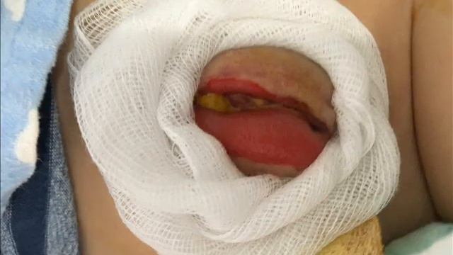 Атрезия ануса Atresia of the anus смотреть онлайн