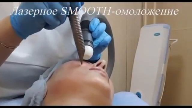 Лазерное смус-омоложение лица смотреть онлайн