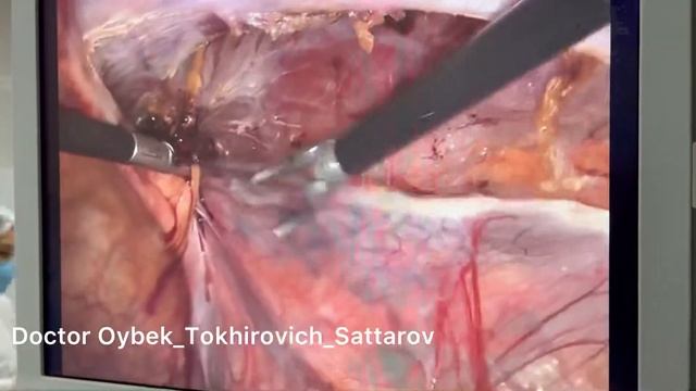 Паховая грыжа. Лапароскопическая герниопластика. Laparoscopic hernioplasty. Д.м.н. Саттаров Ойбек смотреть онлайн