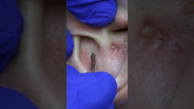 Прогресс чистить уши смотреть онлайн