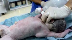 Реанимация новорождённого