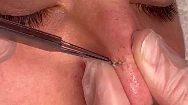 Satisfying video relaxing | blackheads extraction | огромные черные точки | subscribe and be happy? смотреть онлайн