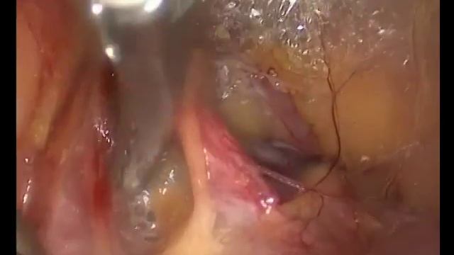 Laparoscopic Pelvic Sentinel Node Biopsy смотреть онлайн