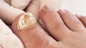 Эта Ядрёная Мазь, Съедает Весь Ногтевой Грибок До Самого Корня! Продается в Любой Аптеке...