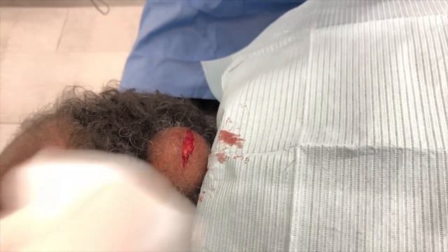 BIGGEST CYST EVER: REPRISE! смотреть онлайн
