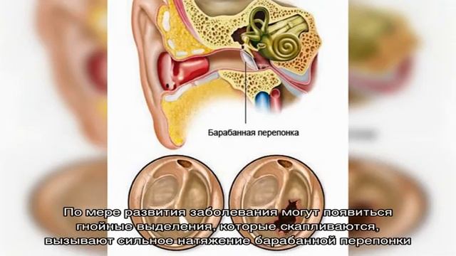 Что такое сальпингоотит
