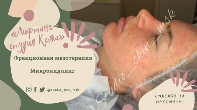Фракционная мезотерапия. Микронидлинг. смотреть онлайн