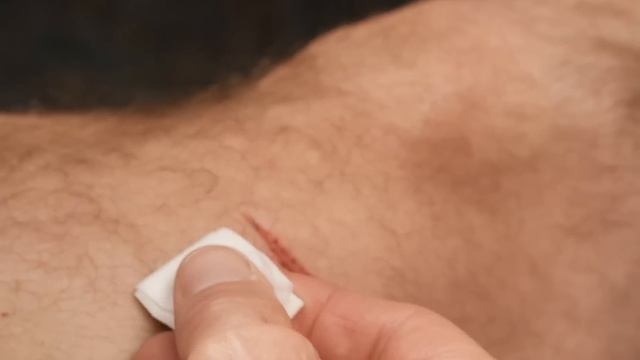 Treating a wound with ZipStitch смотреть онлайн