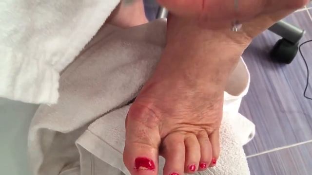 Вросший ноготь - ретро способы лечения