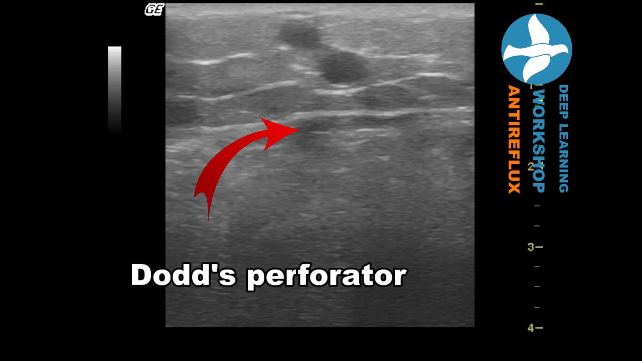 Dodd's perforator смотреть онлайн