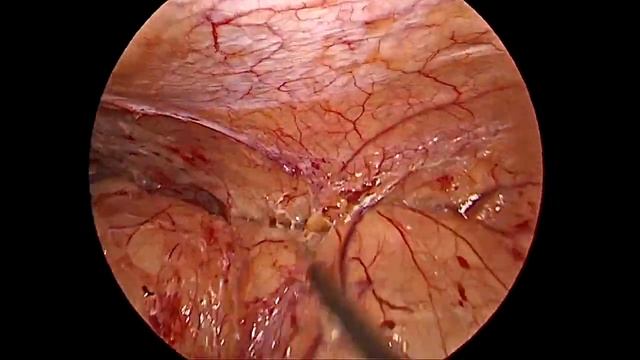Lap Left Radical Nephroureterectomy with Paraaortic, Iliac, Presacral and Obturator Lymphadenectomy смотреть онлайн