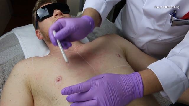Brusthaare DAUERHAFT Entfernen? | #haarentfernung #dauerhaft #IPL #SHR