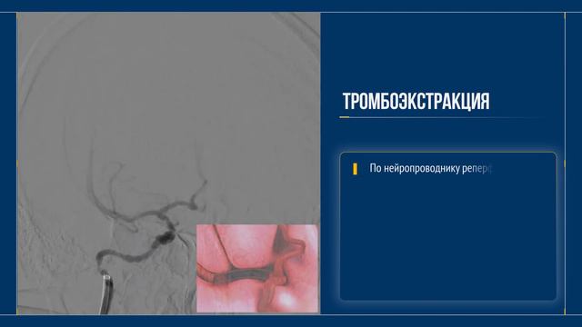 Необычный тромб смотреть онлайн