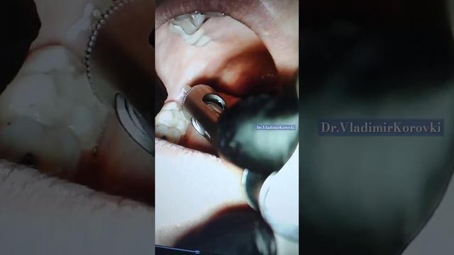 #alveolar inferior nerve block.Right side .проводниковая анестезия справа.#anaesthesia смотреть онлайн
