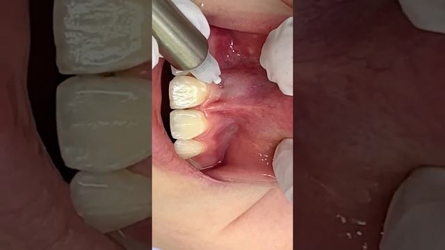 Infiltration Anesthesia Of The Central Incisors / Инфильтрационная анестезия центральных резцов